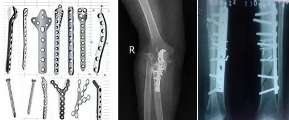 Titanium MRI Compatible Medical Implants: Ti for Orthopedic Safety and Imaging Compatibility Titanium MRI Compatible Medical Implants: Ti for Orthopedic Safety and Imaging Compatibility
