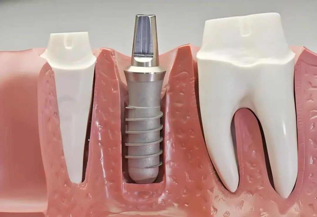 Titanium Material Composition Guide: Pure Ti vs. Alloyed Grades for Industrial Applications
