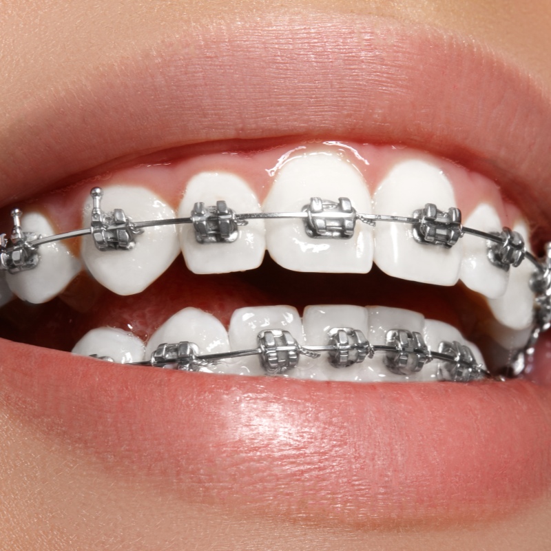 Nickel Titanium Wire​ Orthosis: ultra-elastic and shape memory Improve dental movement efficiency