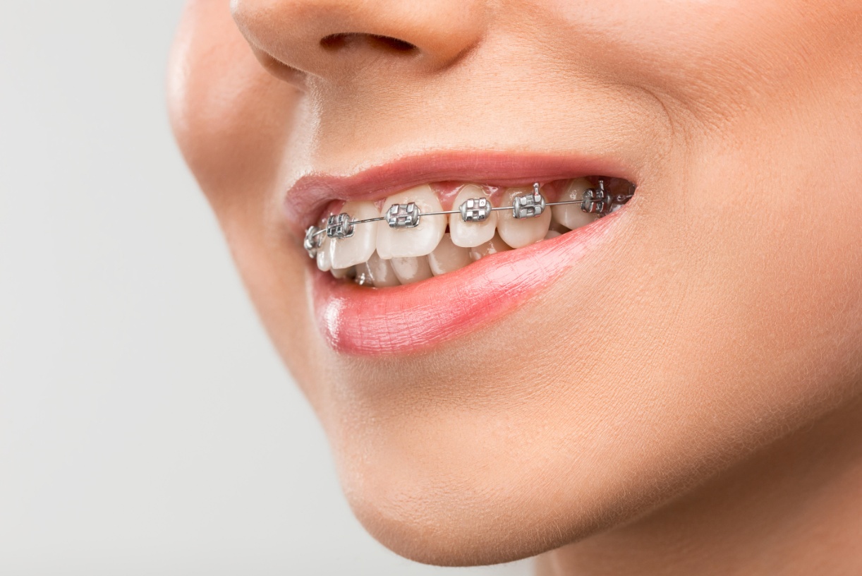 Nickel Titanium Wire​ Orthosis: ultra-elastic and shape memory Improve dental movement efficiency